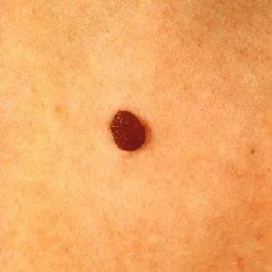 Rosszindulatú melanoma a törzs külső jelek, diagnosztikai módszerek, kezelési módszerek,