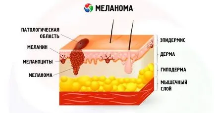 Злокачествен меланом на кожата, симптомите и лечението на злокачествена меланома, компетентен