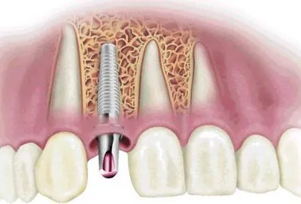 A fogászati ​​implantátum egy rövid, de szükséges oktatási program