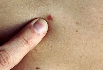 Rosszindulatú melanoma a törzs külső jelek, diagnosztikai módszerek, kezelési módszerek,