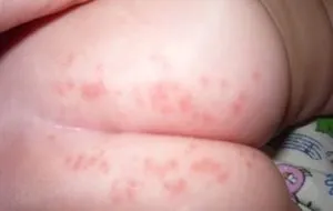 Alergic la scutece cauza bolii, selecția de scutece, tratamente