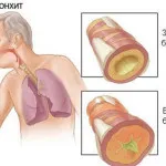 Amoxiclav бронхит при прегледи на децата