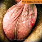 Ateromul scrotal cauza și fotografii