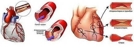 Cauzele cardio aterosclerotice, simptome și tratament