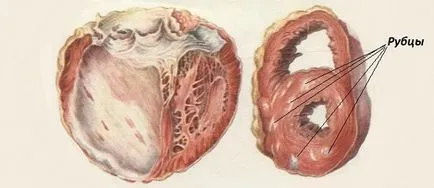 Cauzele cardio aterosclerotice, simptome și tratament