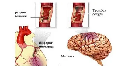 Атеросклеротични сърдечносъдови причини, симптоми и лечение