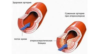 Cauzele cardio aterosclerotice, simptome și tratament