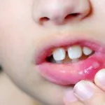 placa albă pe limba unui copil