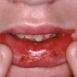 placa albă pe limba unui copil