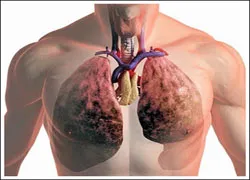 Lung COPD заболяване