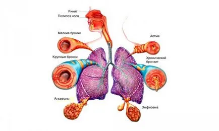 Mennyire veszélyes por bronchitis és hogyan lehet azonosítani