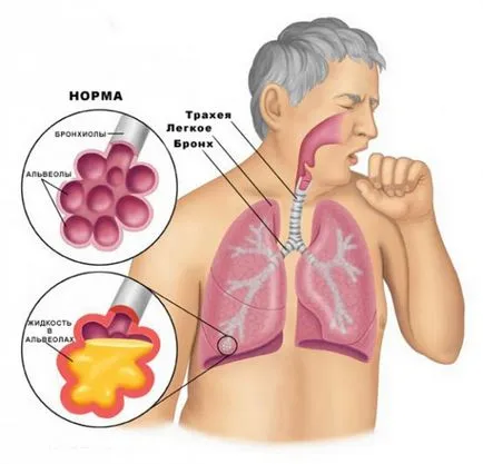 Mennyire veszélyes por bronchitis és hogyan lehet azonosítani