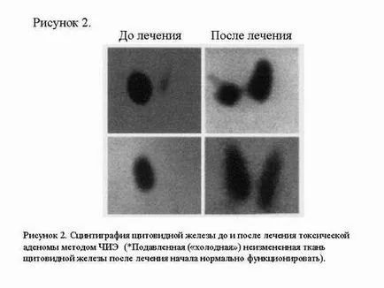 injecție etanol percutana în tratamentul bolilor tiroidiene