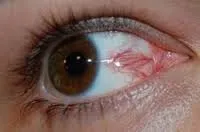Цветни лещи за кафяви очи - общи насоки, ограничения, видове, предимства и недостатъци