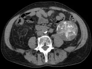 Ce este oncocytomas de rinichi - cauze, simptome, tratament