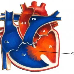 Хипертрофия на дясната камера на сърцето
