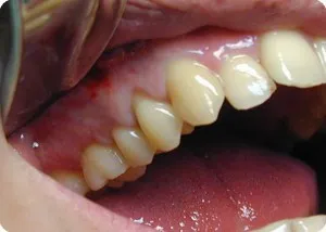 Desecare în guma (foto) arata ca incizie după îndepărtarea dintelui, atunci când fluxul