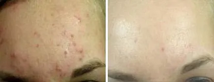 Elos akné kezelésére (acne)