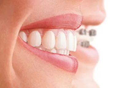 Aligners или скоби