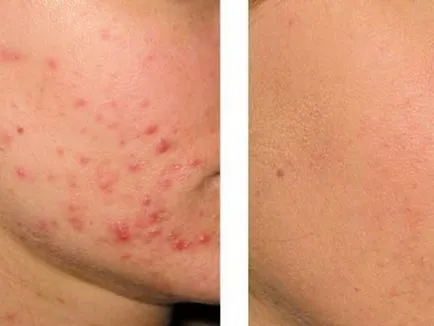 Elos akné kezelésére (acne)