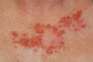 ерозия на кожата причини за симптомите, знаци, лечение