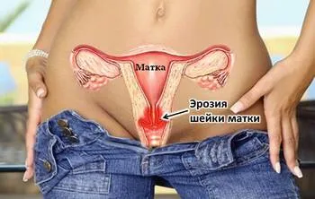 De col uterin eroziune - cauze, simptome, tratament