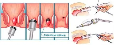 Hemoroizi în timpul sarcinii decât pot fi tratate la comentarii la domiciliu