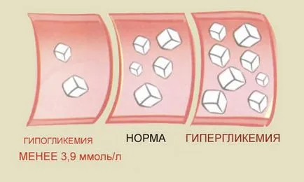 Hipoglicemia în semne de diabet zaharat, simptome, tratament (video)