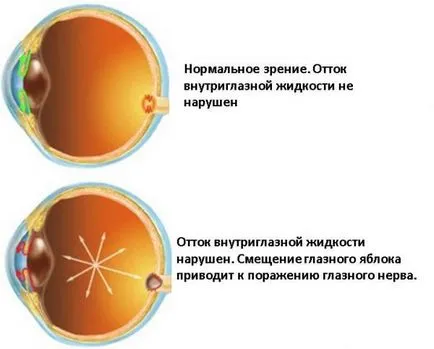 Glaucomul - cum să se ocupe de această boală