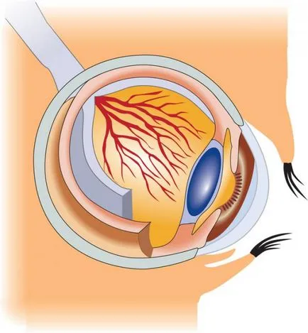 Glaucomul - cum să se ocupe de această boală