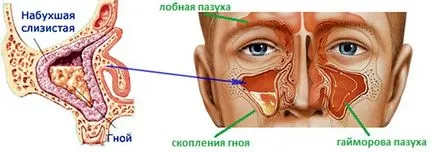 Гноен синузит - Симптоми и лечение на гнойни натрупвания