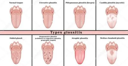 Glossitis nyelv - fotók, tünetei és kezelése, az orvosi oldalon