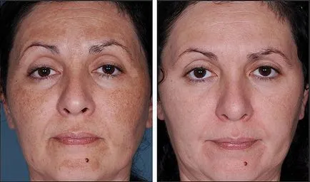 Glycolic coji faciale - argumente pro și contra