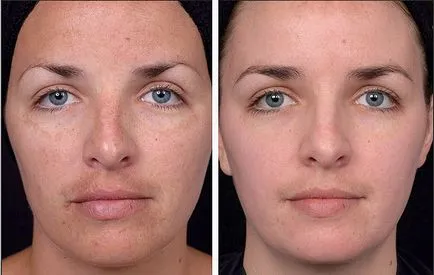 Glycolic coji faciale - argumente pro și contra