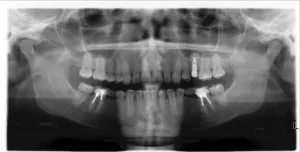 A fogászati ​​implantátumok kulcsrakész Moszkva, fogtechnikai szolgáltatás közepén az implantátum