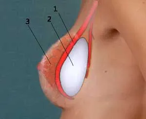 Implanturile si sarcina