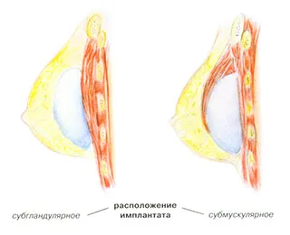 Implanturile si sarcina