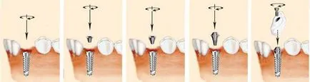 implanturi și implanturi dentare în stomatologie