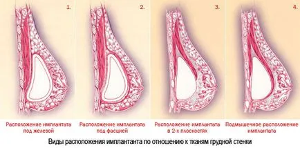 Implanturile si sarcina