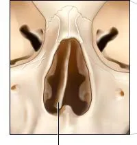 Eltért septum okai és következményei