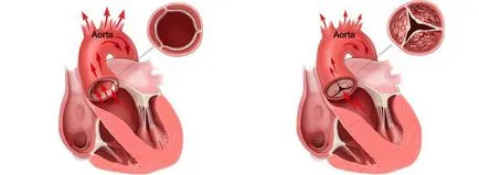 Cum de a trata remedii populare calcifiere aortice