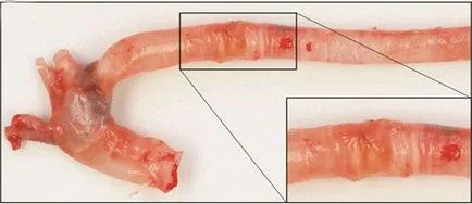 Cum de a trata remedii populare calcifiere aortice