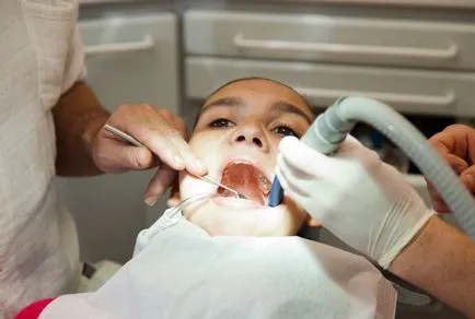 Cum de a trata o fistula asupra gingiilor, după extracția dentară și rezecția rădăcinii principale