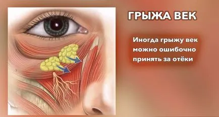 Sérv a szem alatt - okok és a kezelés műtét nélkül, népi jogorvoslati és sebészeti