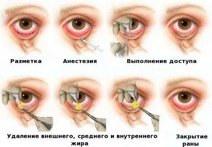 Sérv a szem alatt - okok és a kezelés műtét nélkül, népi jogorvoslati és sebészeti
