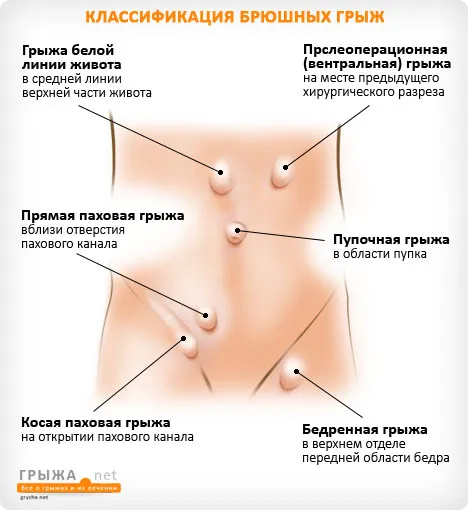 Коремни херния симптоми на коремната Ryzhi и третиране