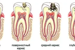 Как да спре упадъка на бебешки зъби