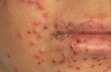 Cum se manifesta forme atipice de leziuni herpetice ale pielii