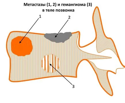 Hogy áttétek gerincvelői áttétek a gerinc élettartam metasztázisok