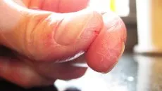 Hogyan lehet gyógyítani a repedések az ujjak